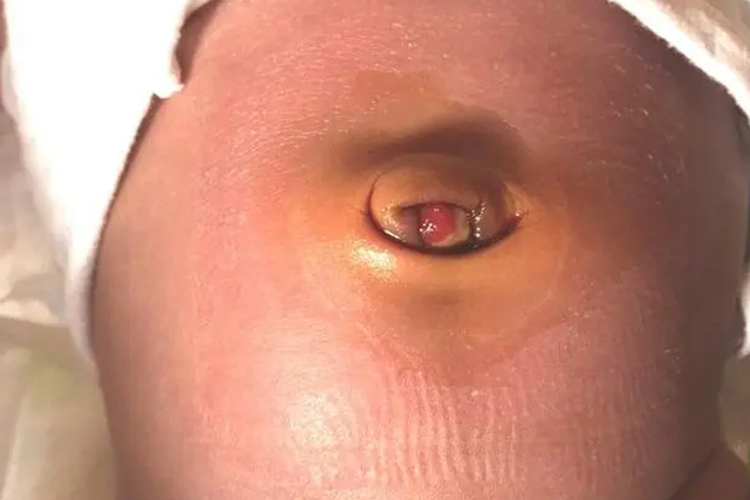 新生儿脐茸图 新生儿脐茸图