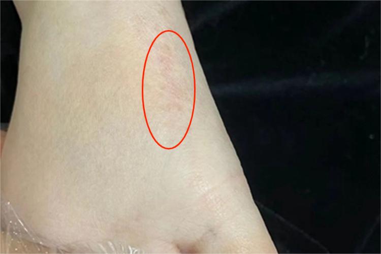 线状苔藓脚背丘疹图