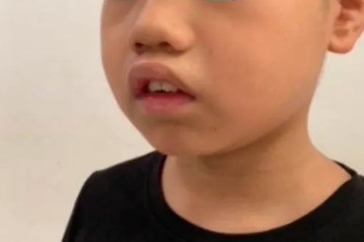 腺样体肥大上嘴唇突出图