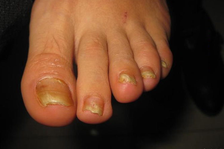 甲营养不良趾甲图