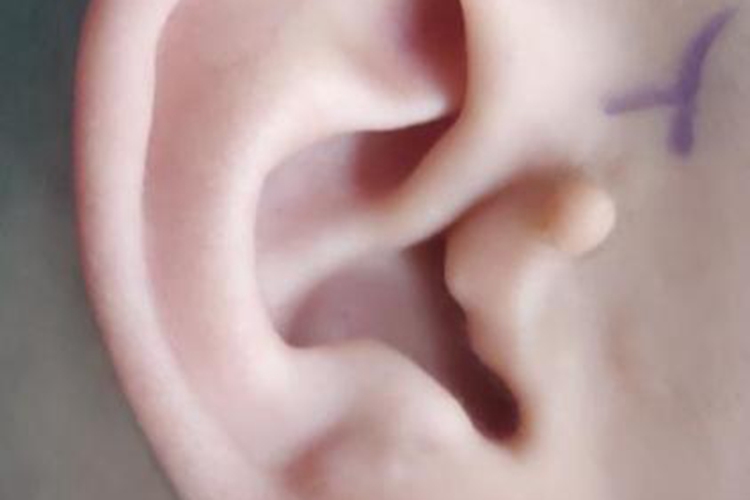 新生儿副耳图 新生儿副耳图