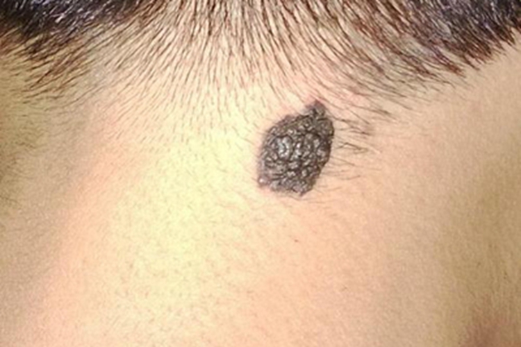 黑素细胞痣后颈大疙瘩图 黑素细胞痣后颈大疙瘩图