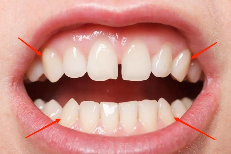 正常尖牙位置图