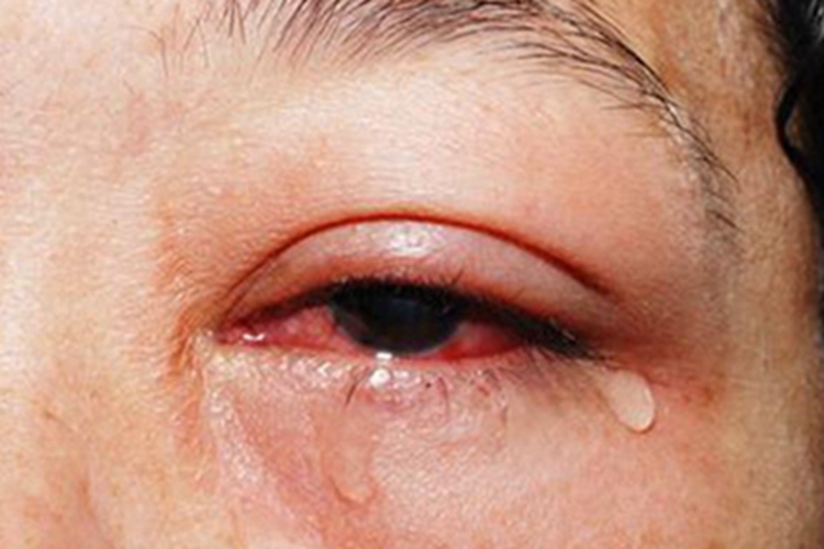 红眼病眼部红肿图 红眼病眼部红肿图