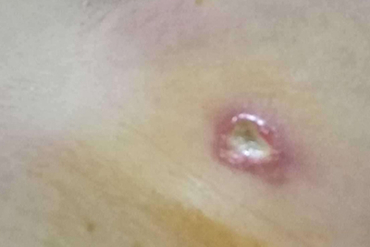 乳腺微创手术后伤口发炎图