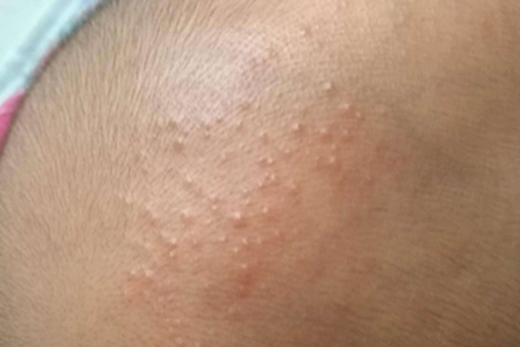 皮脂腺增生头皮丘疹图