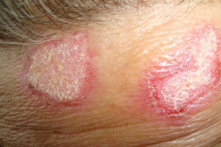 盘状红斑狼疮图