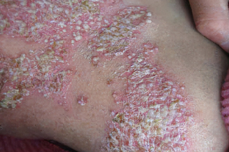 点滴状银屑病静止期图