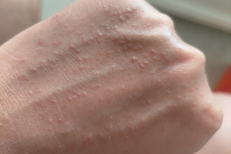急性接触性皮炎手背小疙瘩图