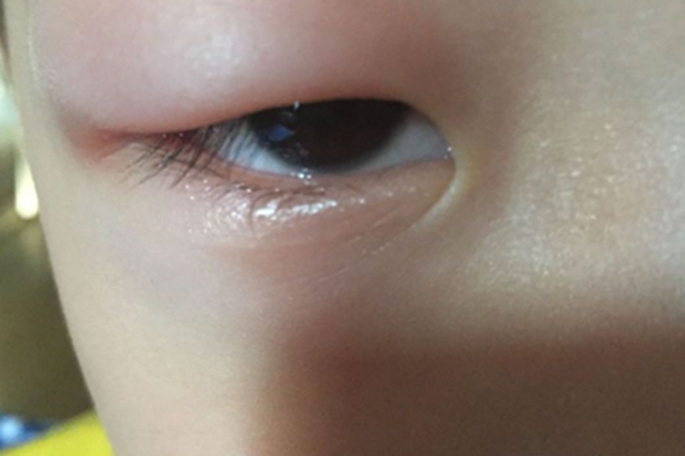 皮肤过敏眼睑红肿症状图