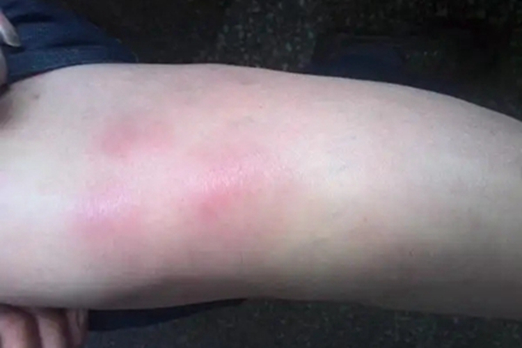 硬红斑小腿红肿明显图