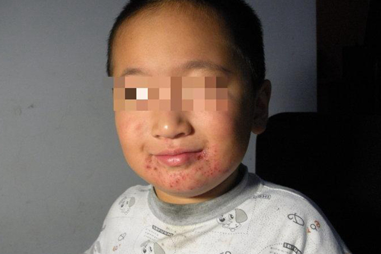 儿童须疮图 儿童须疮图