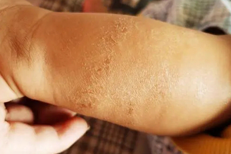 着色性干皮病图