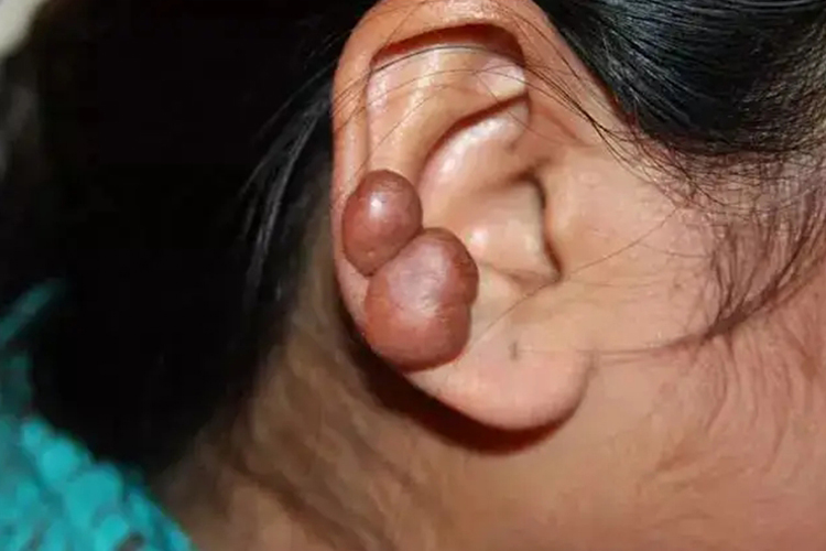 耳蜗钉增生图 耳蜗钉增生图