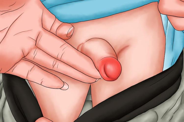 包皮过敏性水肿图