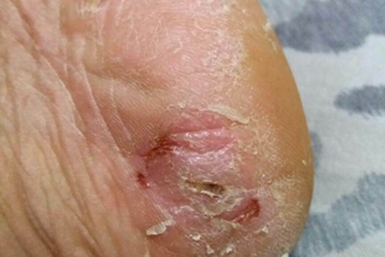 Ⅲ度皮肤皲裂症状图