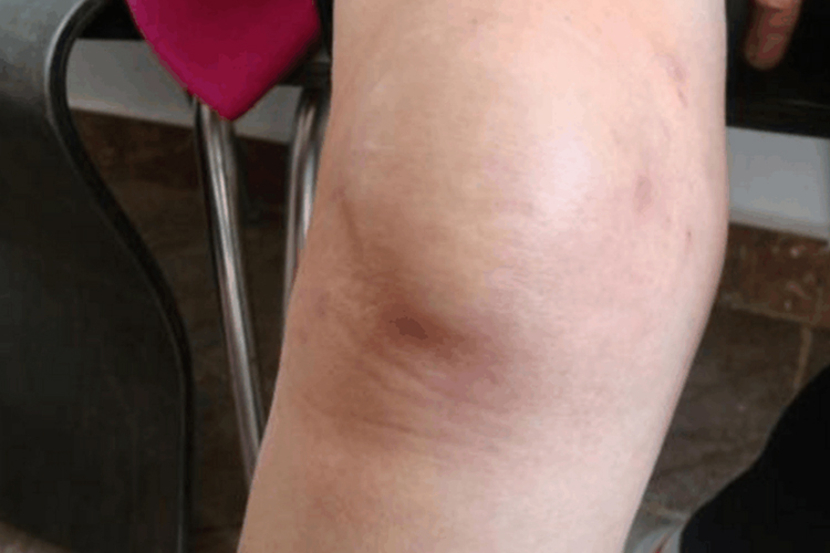 半月板损伤膝盖内侧肿胀图