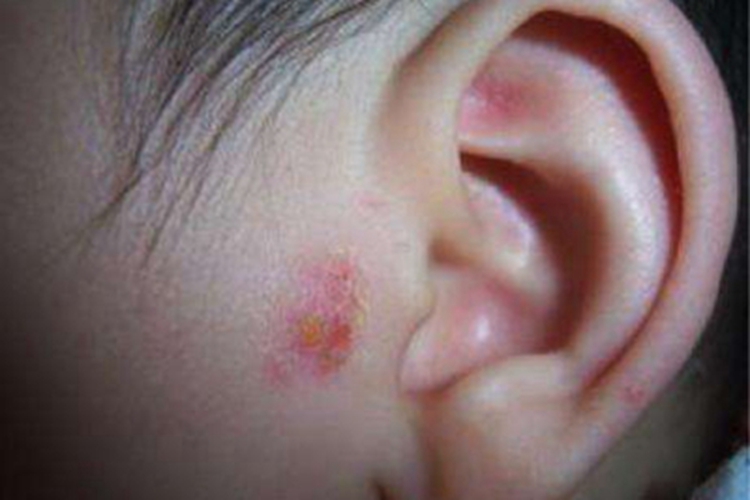 虱病耳前丘疹图
