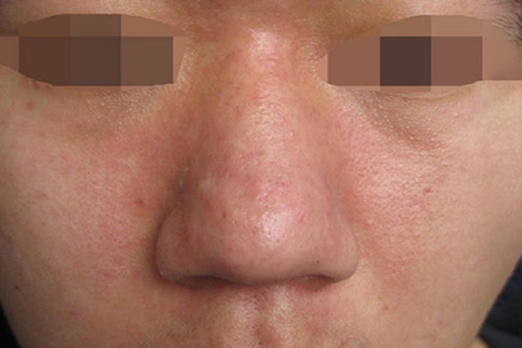 弥漫充血性针尖大小的丘疹图