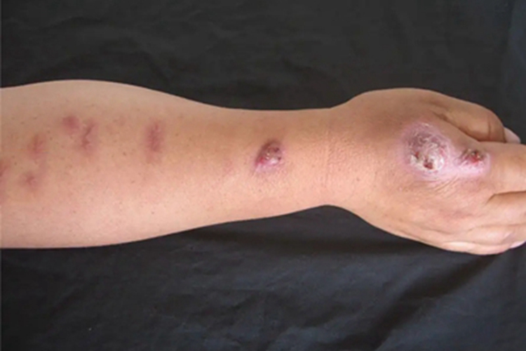 皮肤钙质沉着症胳膊结痂图