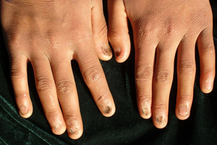 指甲萎缩手指甲特别小图