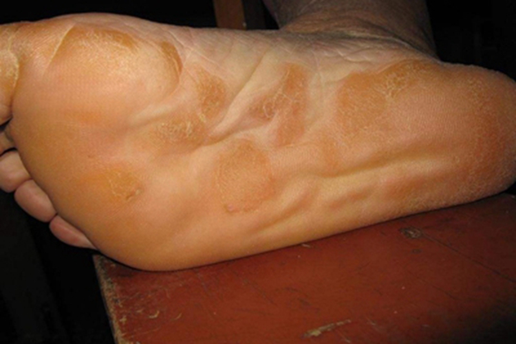 围绝经期角皮症脚底症状图