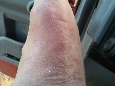 干燥病脚部大面积干燥起白屑图.jpg