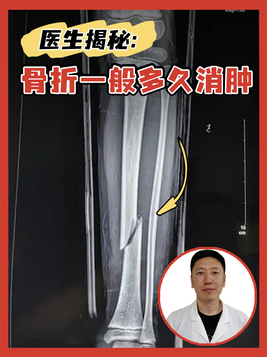 医生揭秘：骨折一般多久消肿