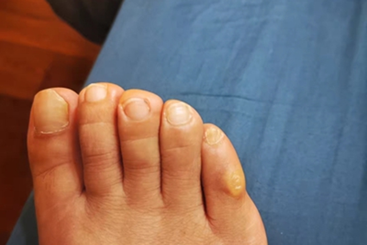 鸡眼脚部硬块图