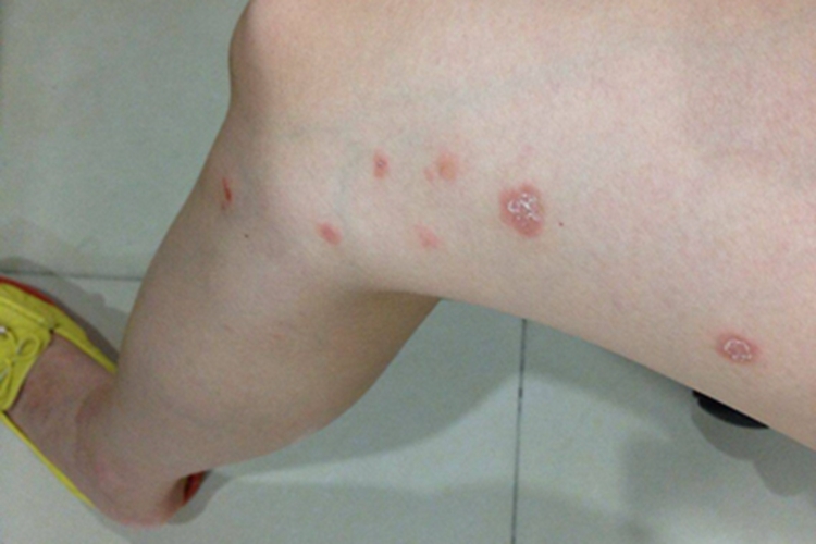 革螨皮炎大腿症状图 革螨皮炎大腿症状图