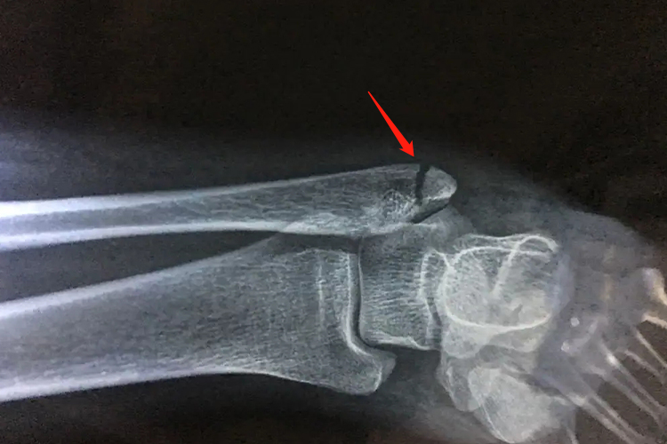 左腓骨外踝骨折X线有裂缝图