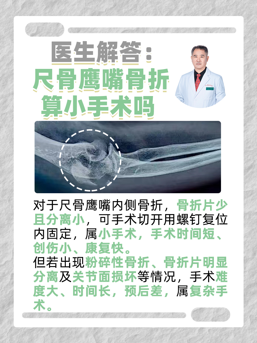 医生解答：尺骨鹰嘴骨折算小手术吗