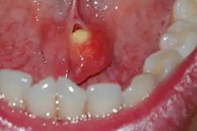 唾液腺结石腺体肿胀图