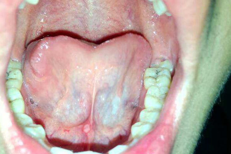 舌头下面口腔白角化症图