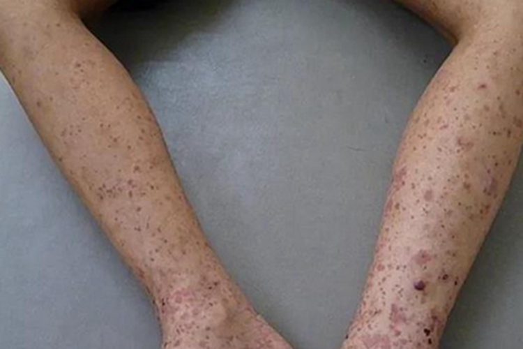 单纯性紫癜小腿症状图 单纯性紫癜小腿症状图