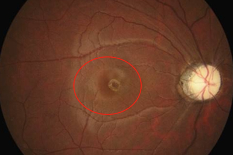 慢性铊中毒视网膜水肿图