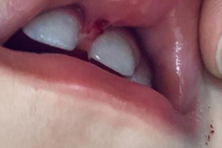 唇系带断裂图 唇系带断裂图