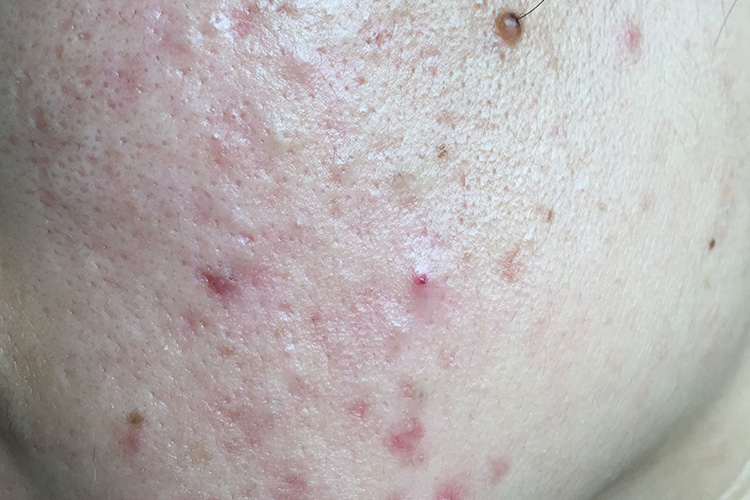 点状痤疮图 点状痤疮图