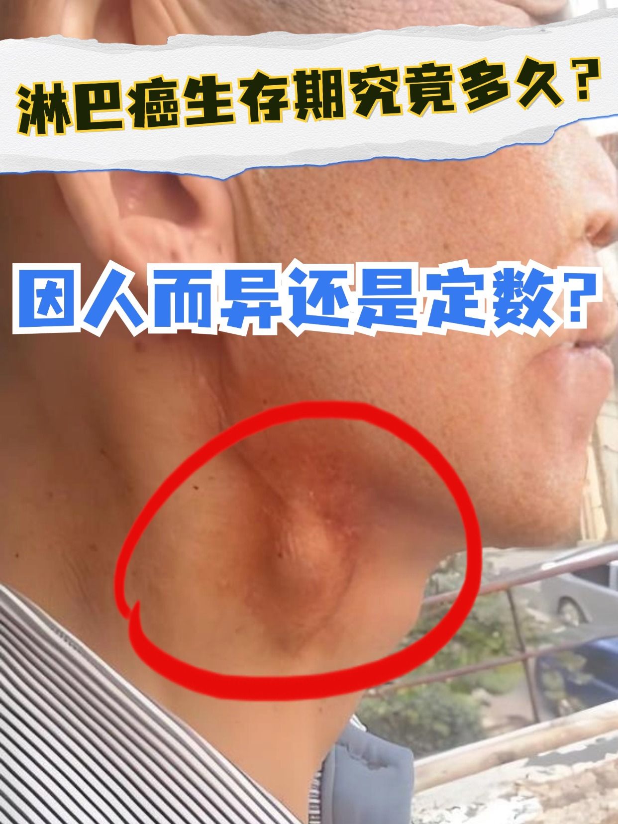 淋巴癌生存期究竟多久？因人而异还是定数？