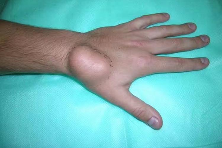 手背脂肪瘤图 手背脂肪瘤图
