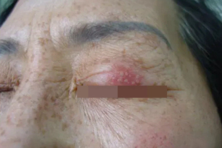 单纯疱疹性角膜炎眼睑小水疱图 单纯疱疹性角膜炎眼睑小水疱图