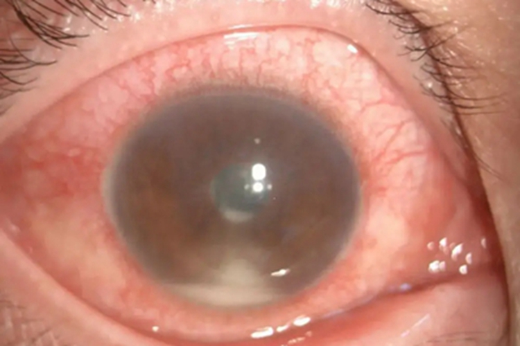 虹膜睫状体炎症状图