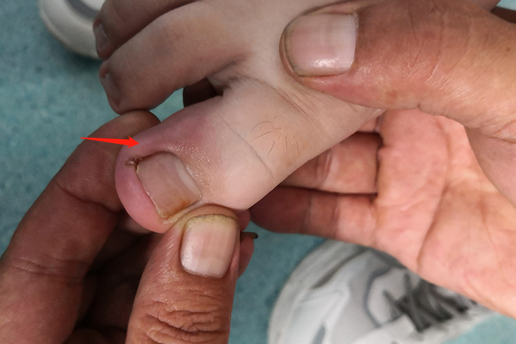 甲沟炎脚趾头肿图