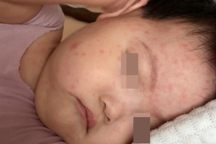 幼儿急疹脸上都是小疙瘩图