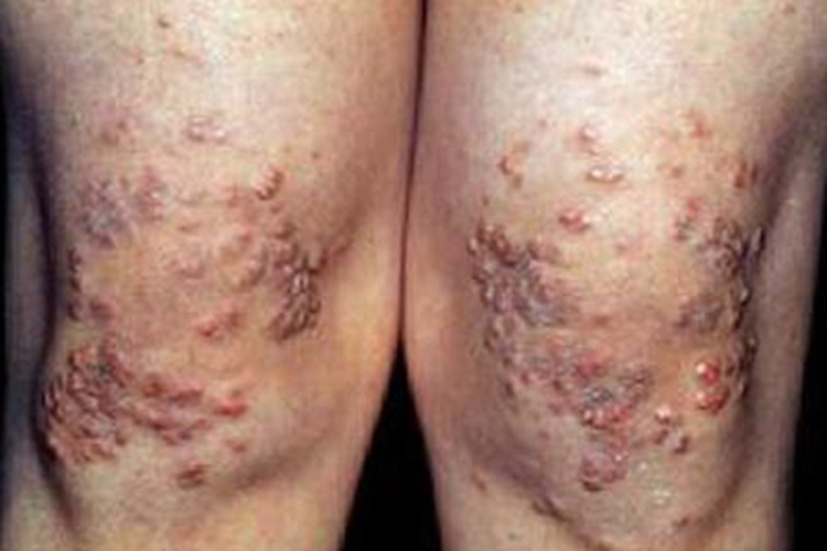 结节性黄瘤膝盖小疙瘩图