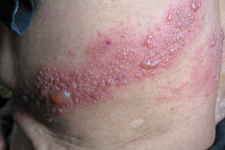 带状疱疹水疱图