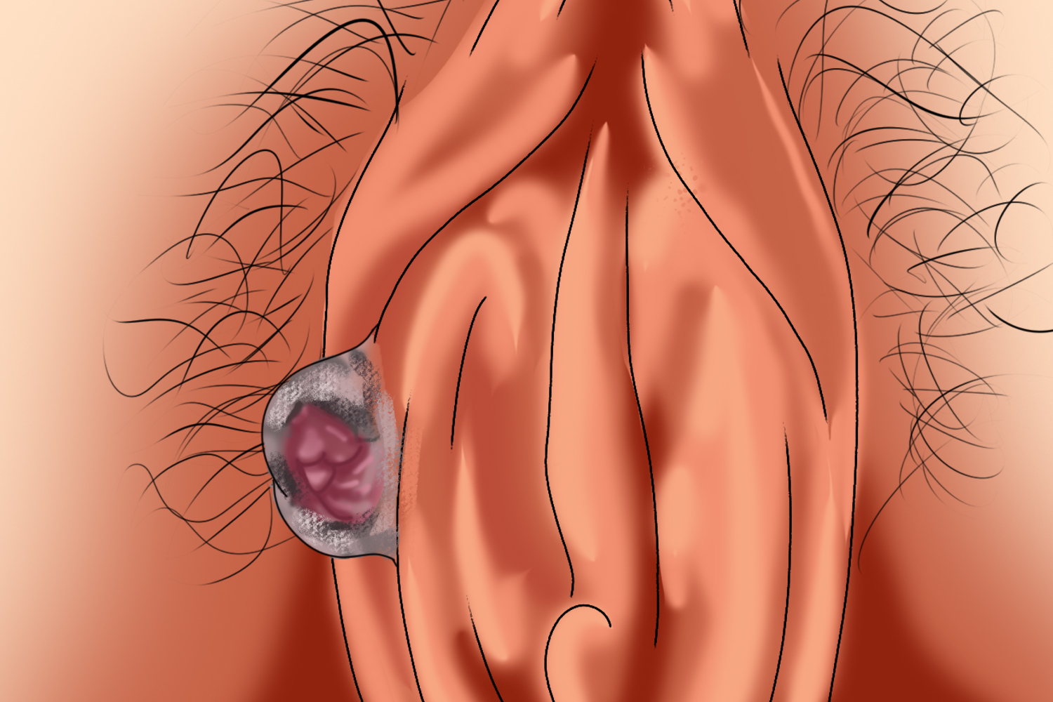 外阴软纤维瘤图