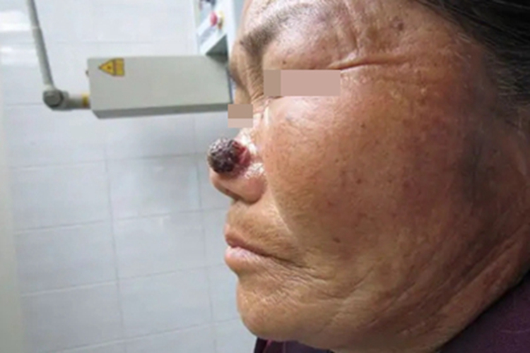 皮肤基底细胞癌鼻部大疙瘩图 皮肤基底细胞癌鼻部大疙瘩图