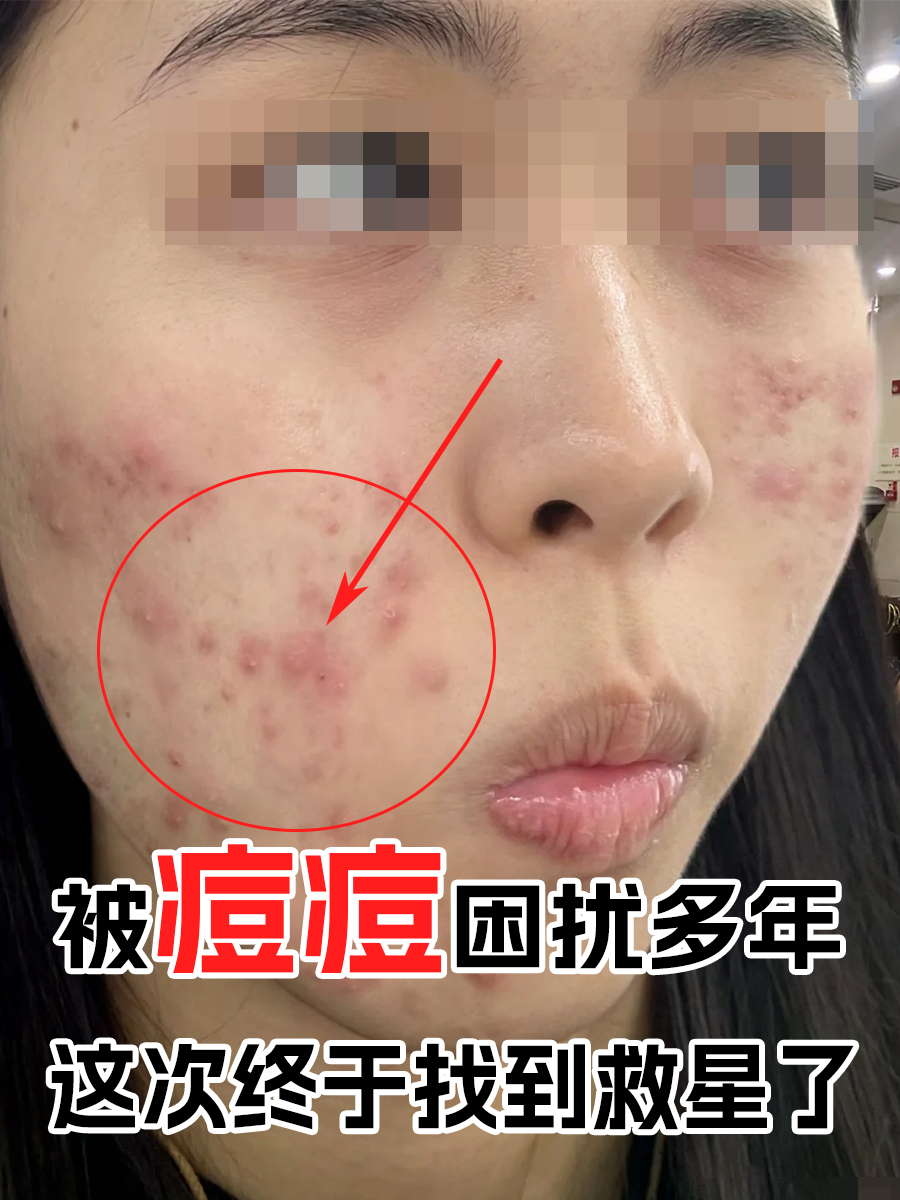 被痘痘困扰多年,这次终于找到救星了