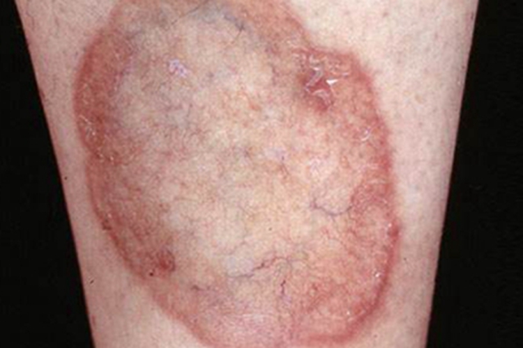 毛细血管扩张性环状紫癜症状图